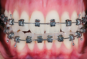Invisalign West Chester