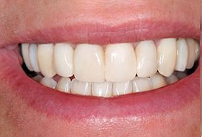 West Chester Dental Smile Center | Cosmetic Dentistry, Invisalign reg  and Dentures