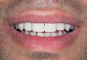 West Chester Dental Smile Center | Oral Cancer Screening, Preventative Program and Orthodontics